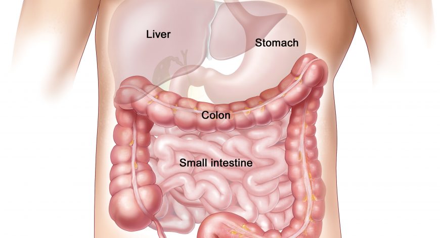 Sindromul de colon iritabil și cancerul